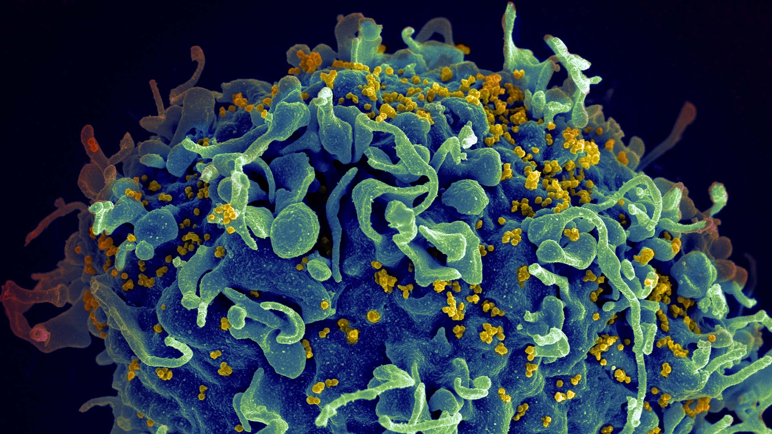 We've learned a lot about the HIV virus, shown here,  in yellow, attacking a human T cell. But state laws criminalizing its spread have not kept pace  with the science.