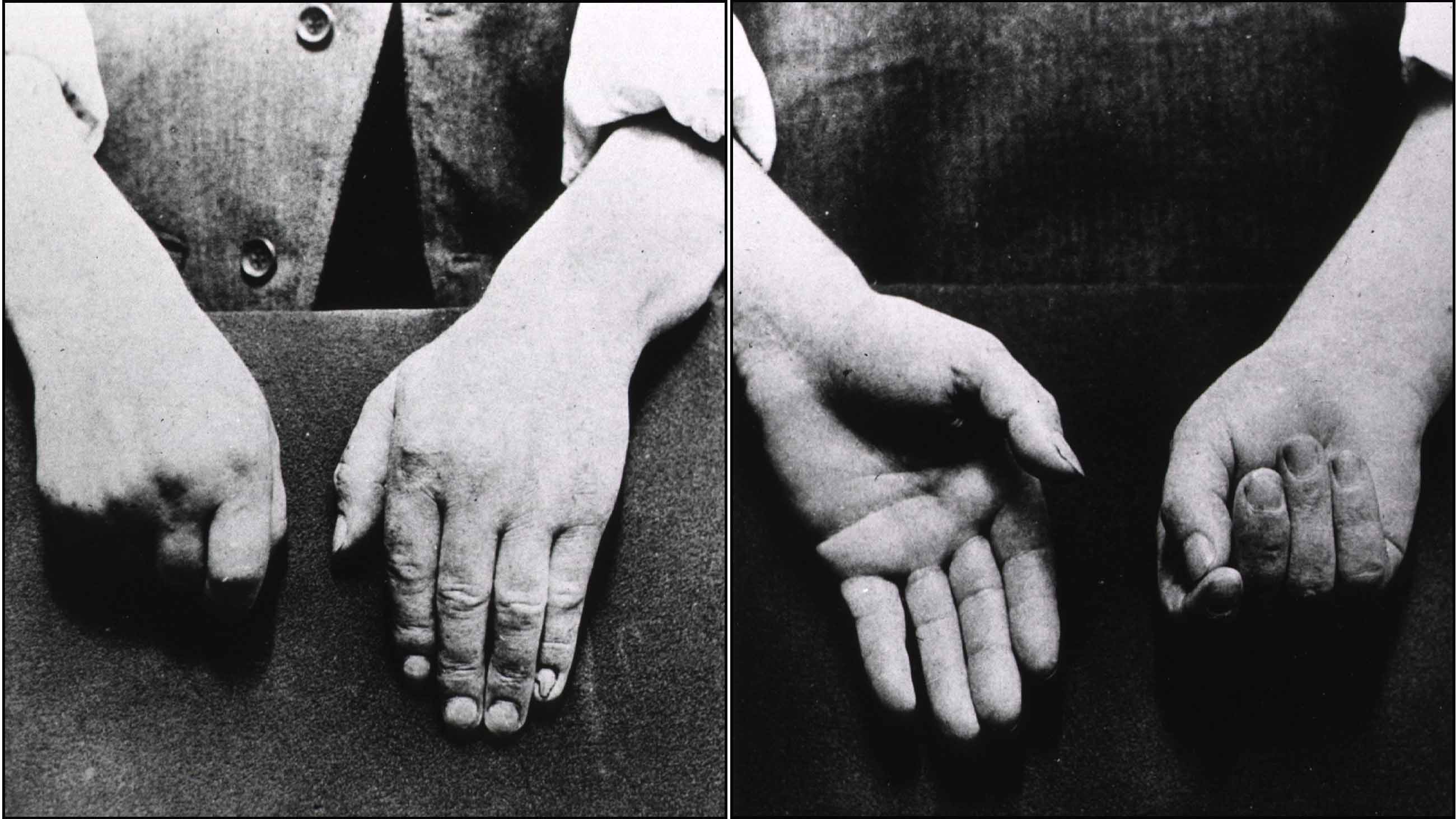 1892 photos showing effects of Parkinson's disease, from the front and behind the patient's back.