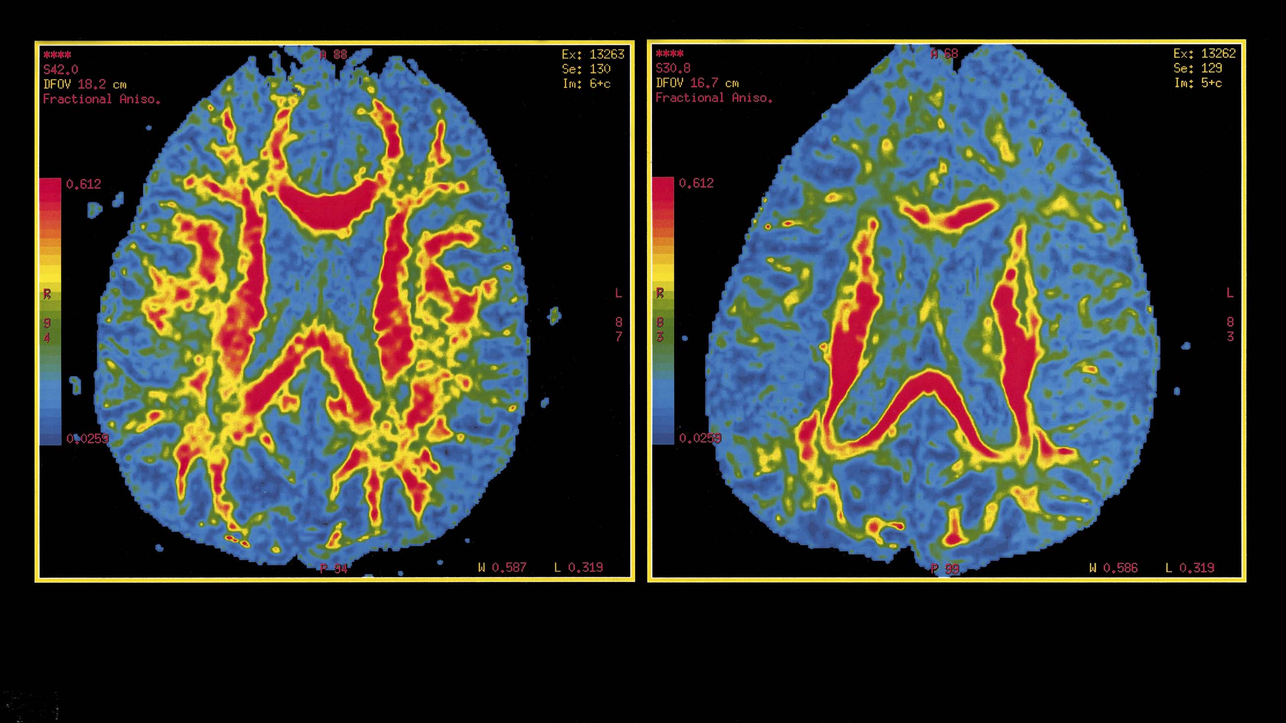 Training AI to Predict Alzheimer&#39;s Disease
