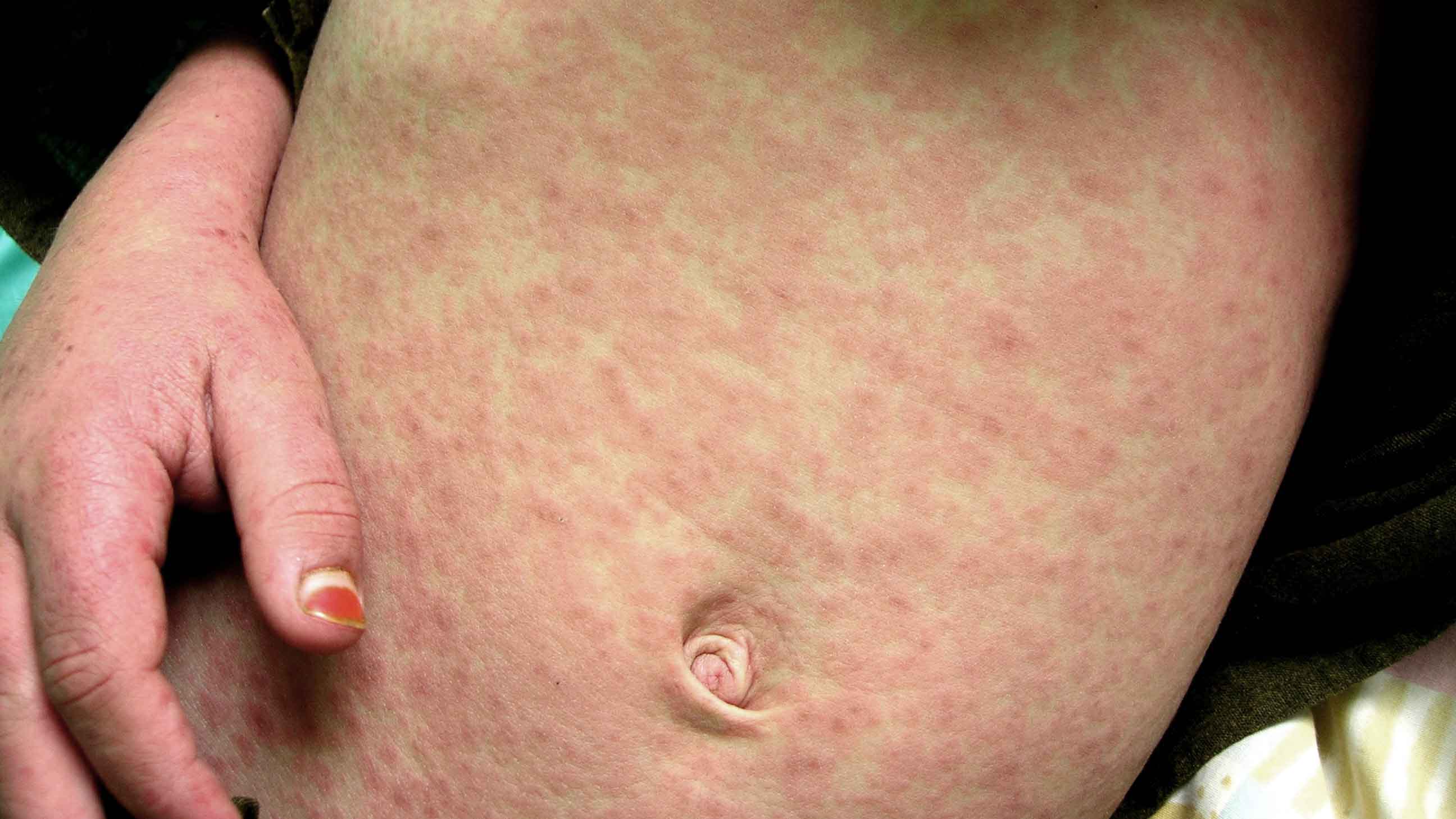 Measles cases have been documented in 22 states this year. One of the most recognizable symptoms is a full-body rash.