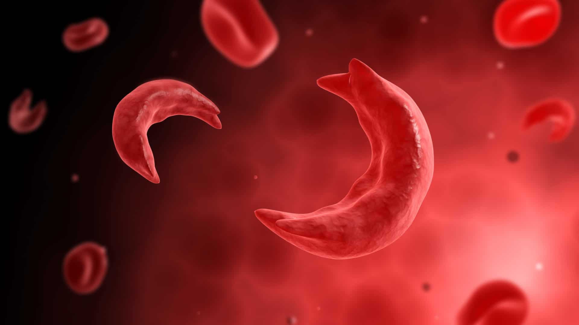 Sickle cell disease causes a patient's cells to  take on an abnormal C shape that can cause blockages and lead to stroke and organ damage, among other complications.