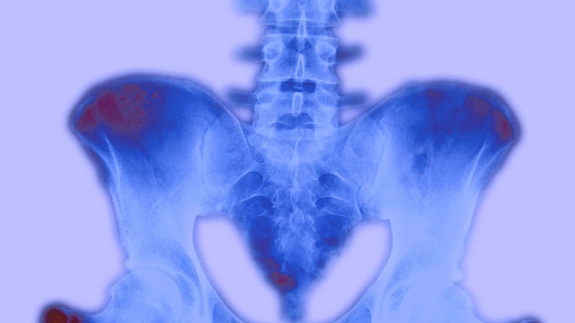 The Problem MRIs for Back Pain