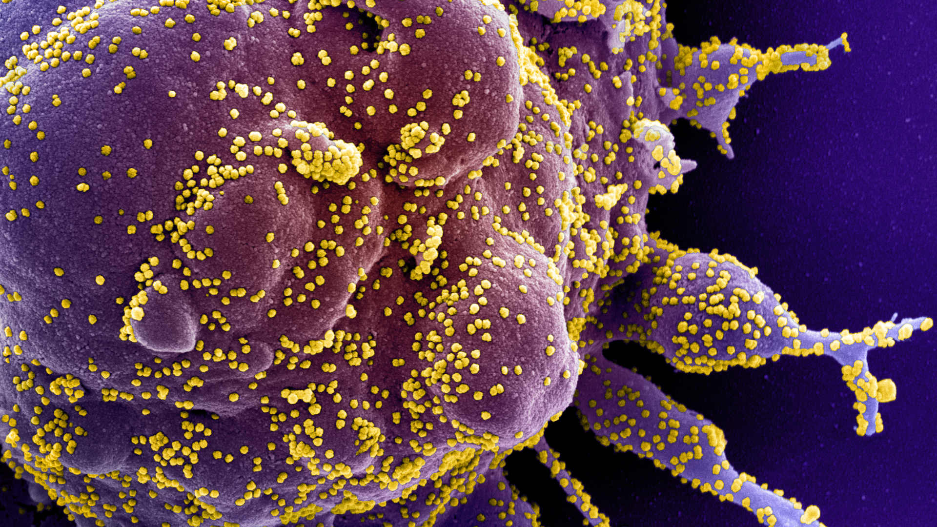 Electron microscope image of a human cell (purple) heavily infected with SARS-CoV-2 virus particles (yellow).