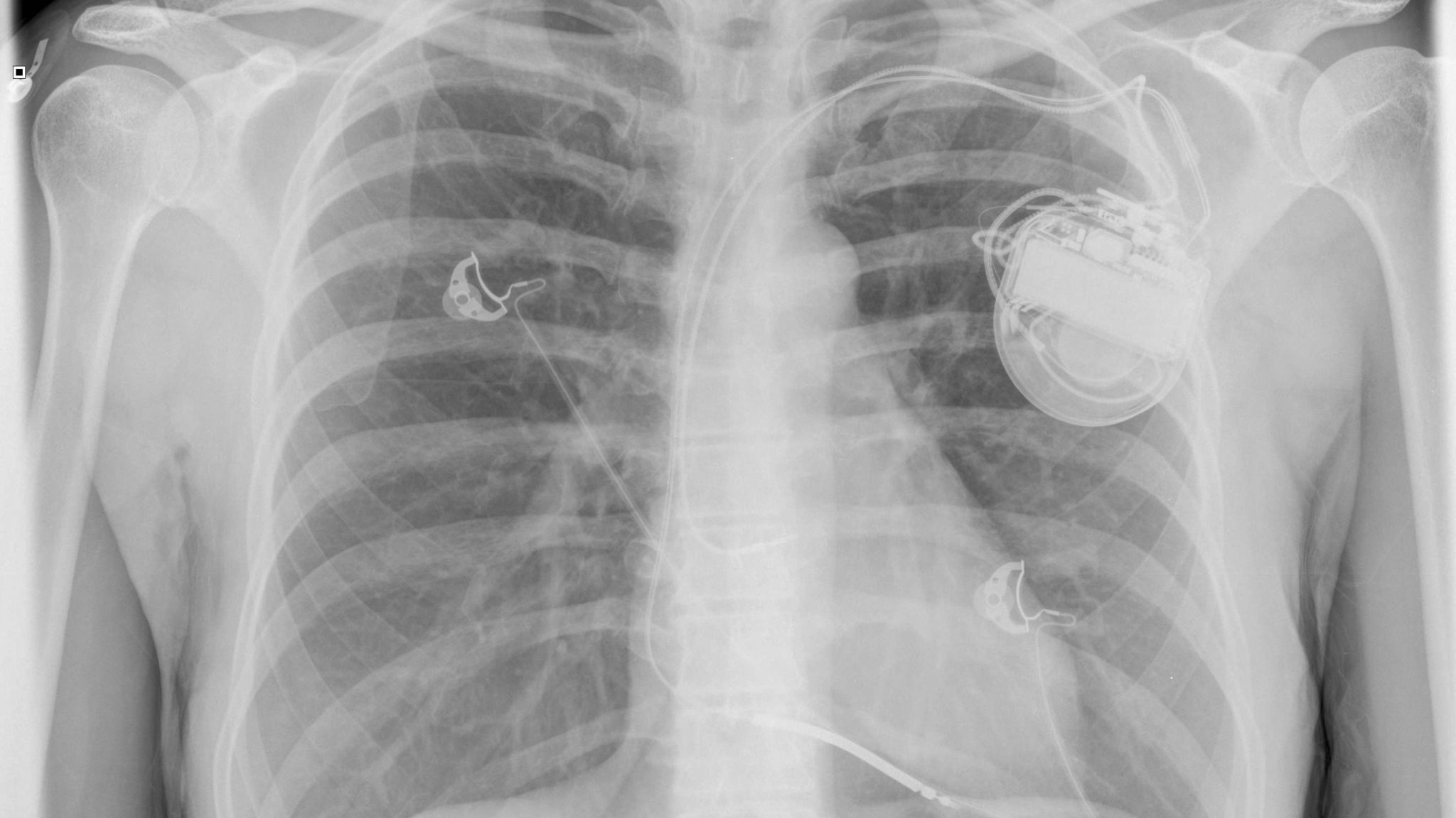 Chest x-ray showing an implantable cardiac defibrillator.