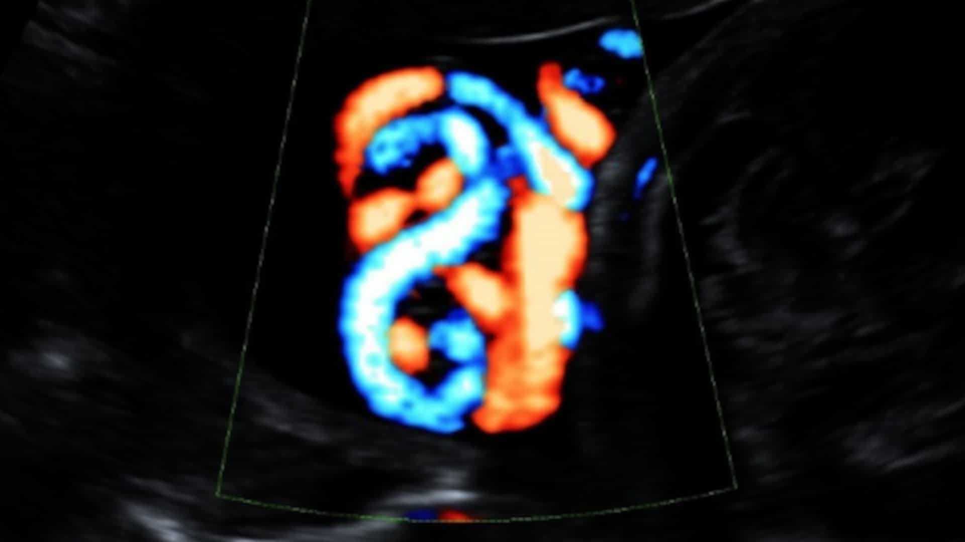 A true umbilical cord knot, viewed by an imaging technology called 3D HD Flow.