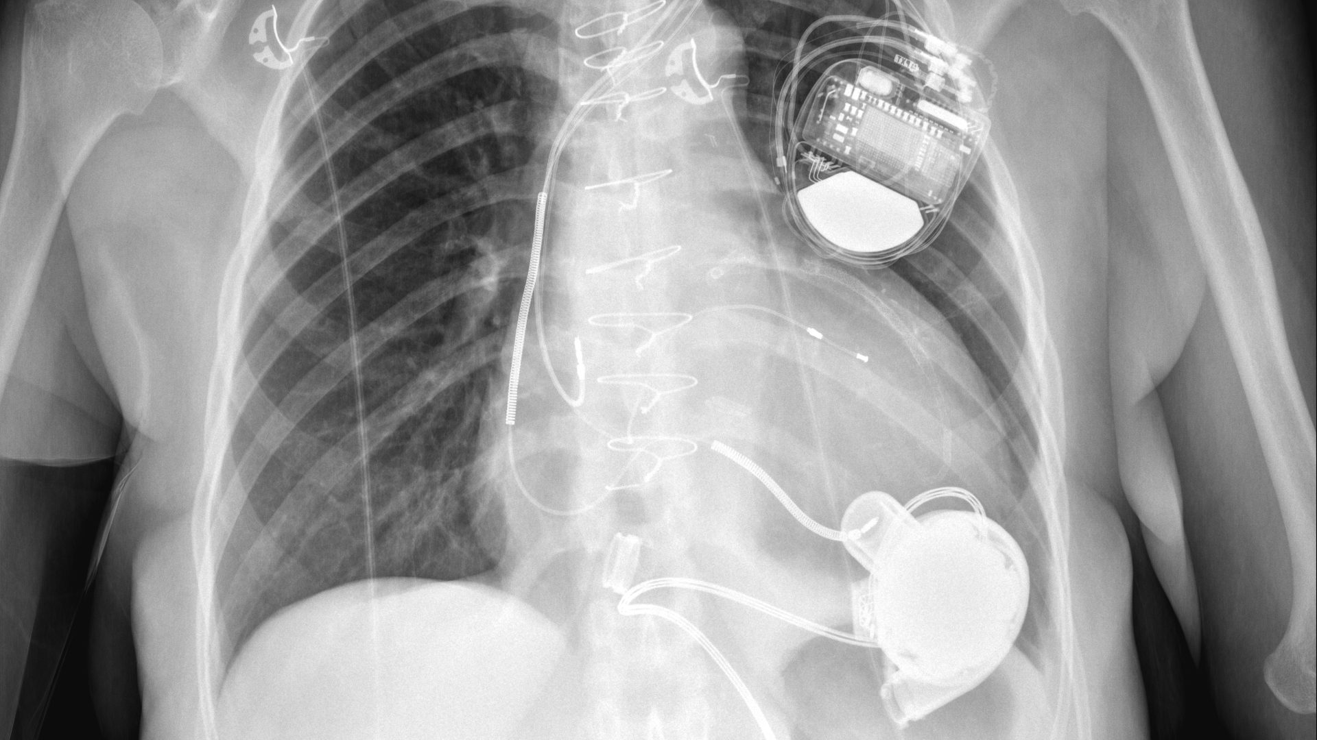 Chest X-ray showing the placement of a HeartWare device.