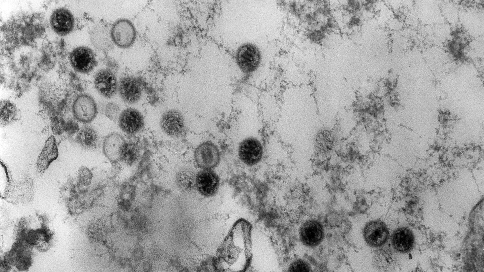 Wissenschaftler debattieren über die Rolle eines Virus bei Multipler Sklerose
