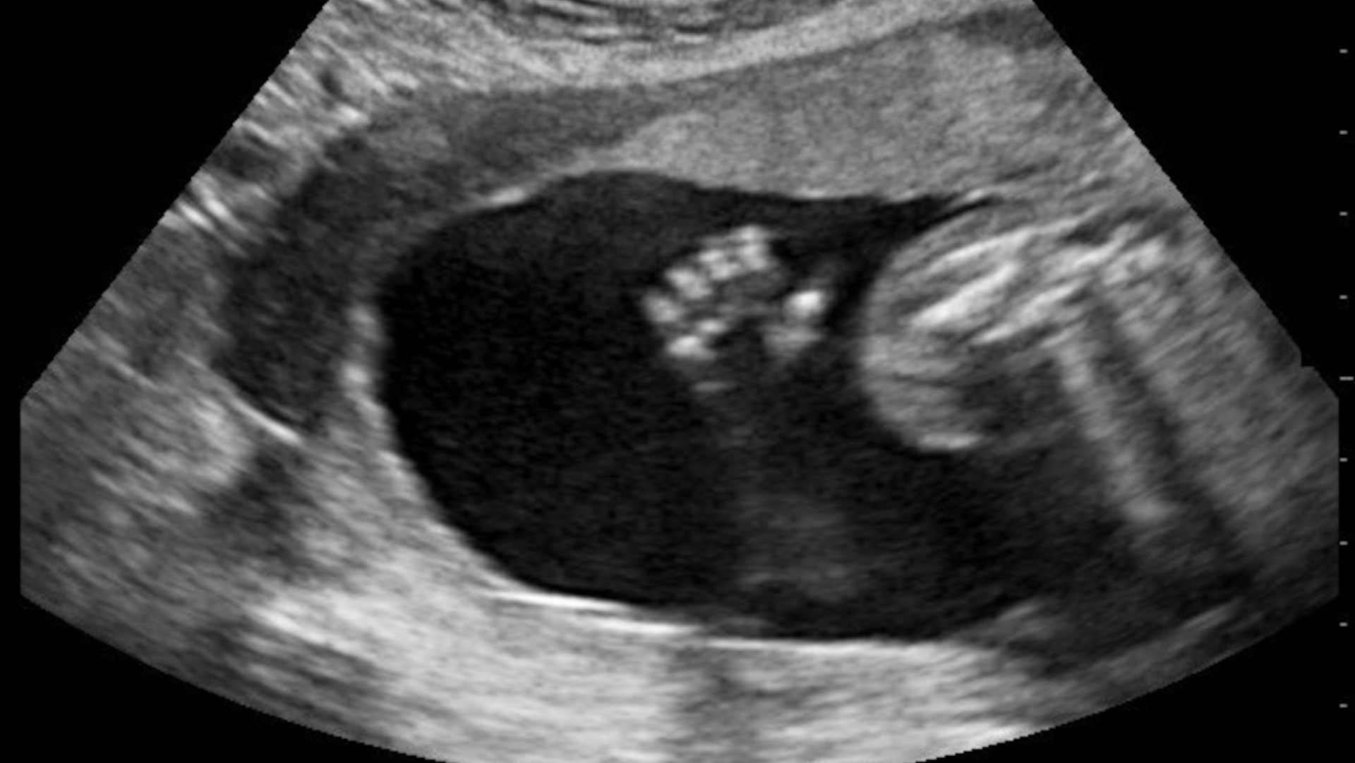 A fetal ultrasound.