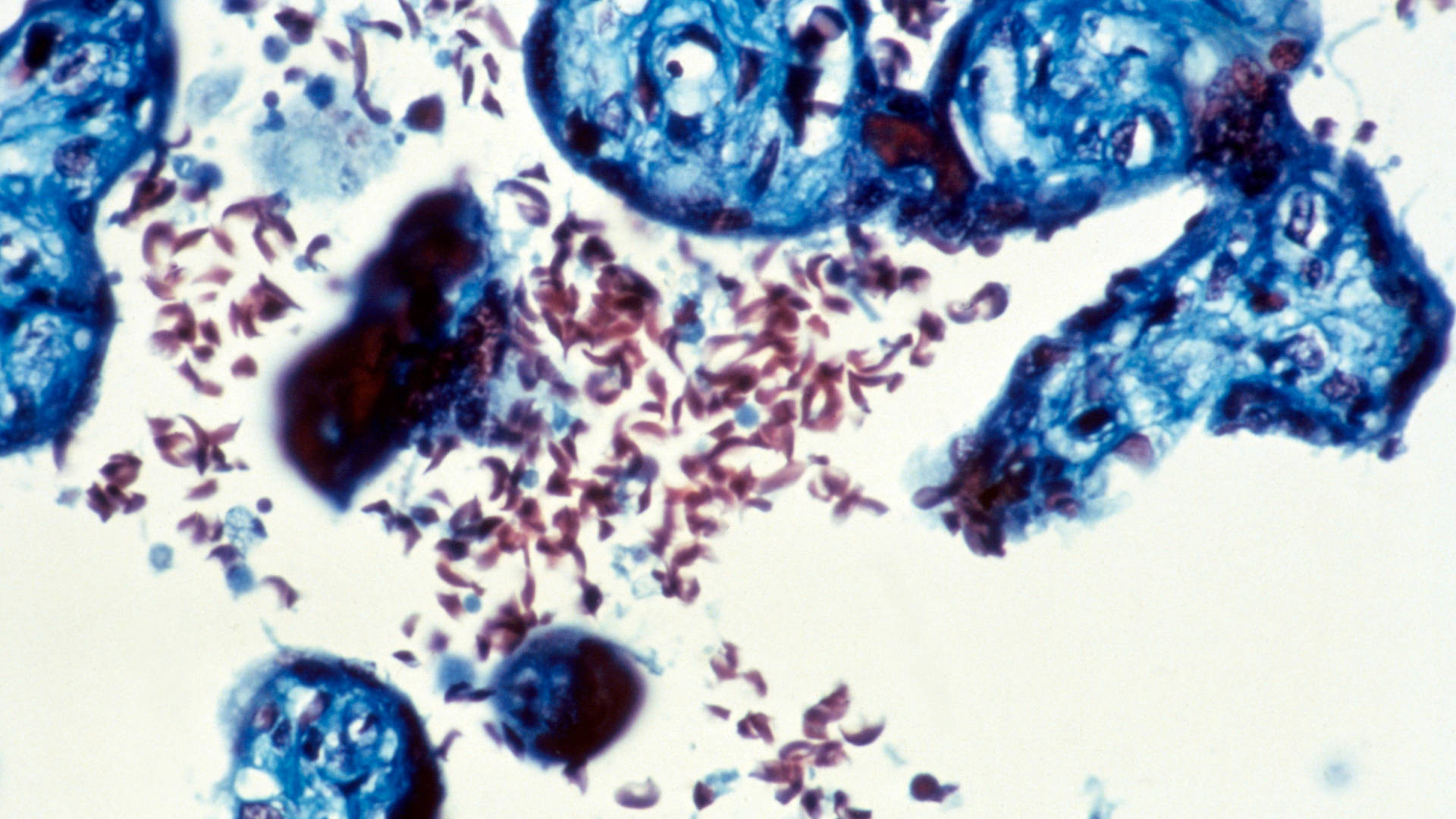 Microscope image of the placenta from a woman with sickle cell disease, showing sickled red blood cells (purple) and placental villi (blue).
