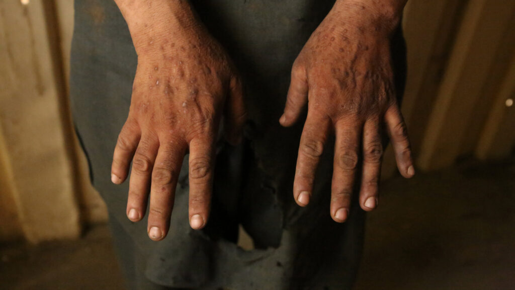 A scrap worker named Anwar has worked outside Bagram airfield for eight years. He has had a rash on his hands for six years and believes it is caused by his work.