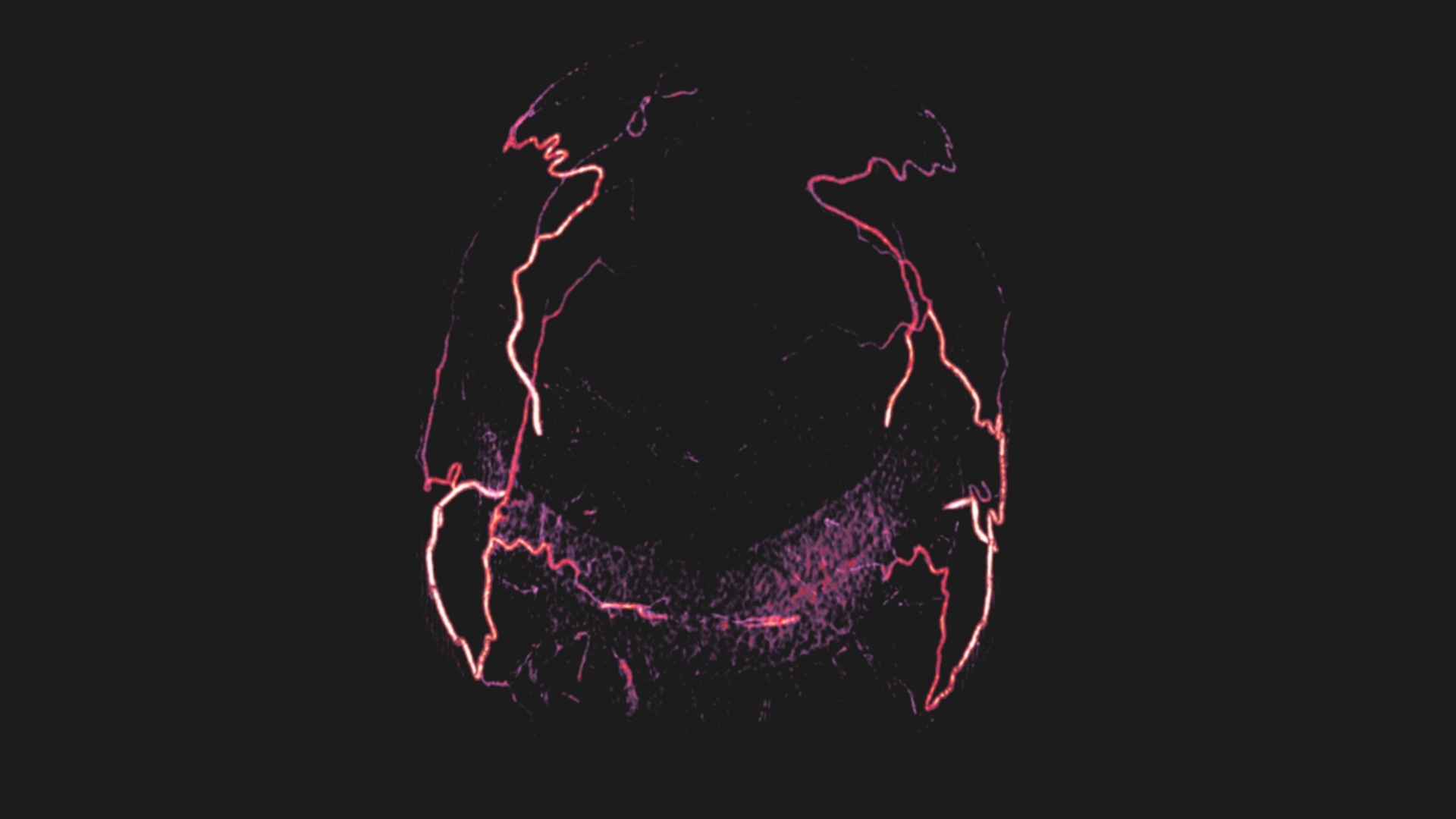 Imaging of the head of a brain-dead patient show filling of the artery branches in the scalp, but filling of the arteries in the brain is absent.