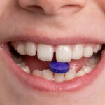 Detailed close-up of a person smiling with a purple pill balanced between their teeth